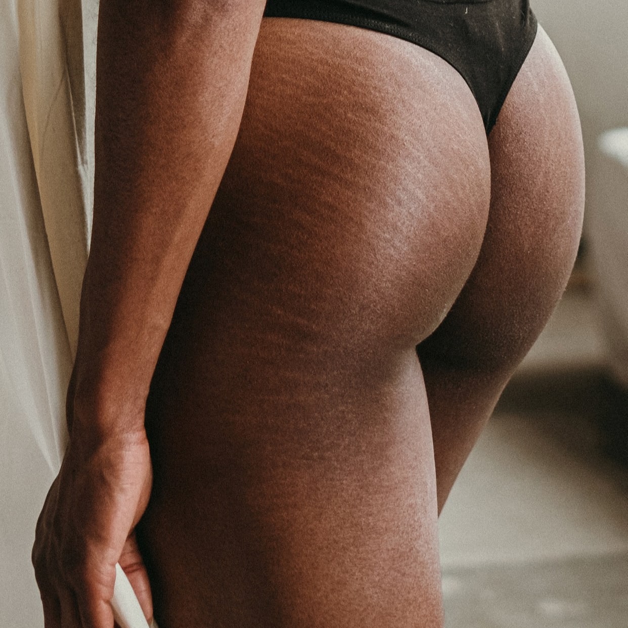Every Treatment And Procedure That Helps Minimize Stretch Marks