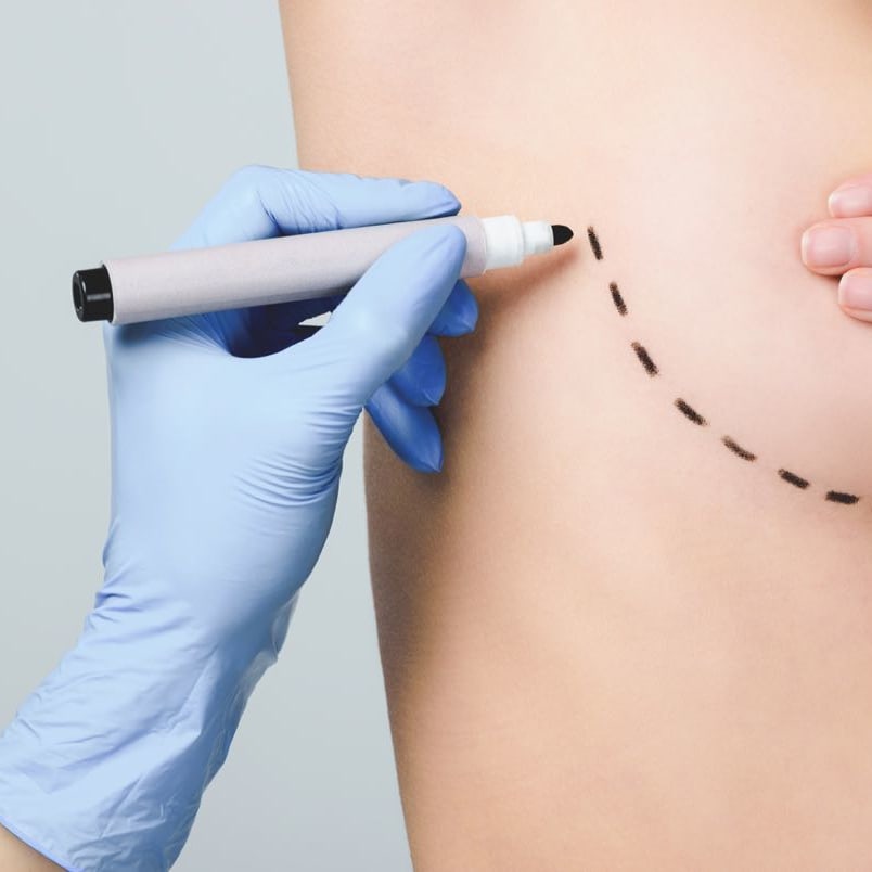Here’s What You Need To Know About Replacing Breast Implants