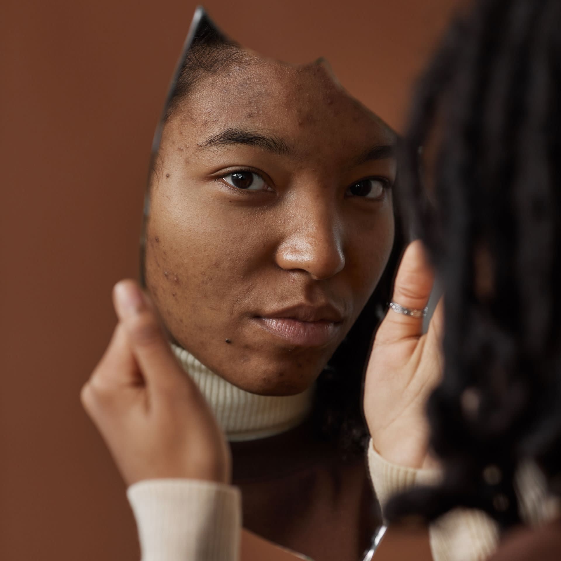 Acne Scar Treatment: Why One Treatment Is Rarely Enough