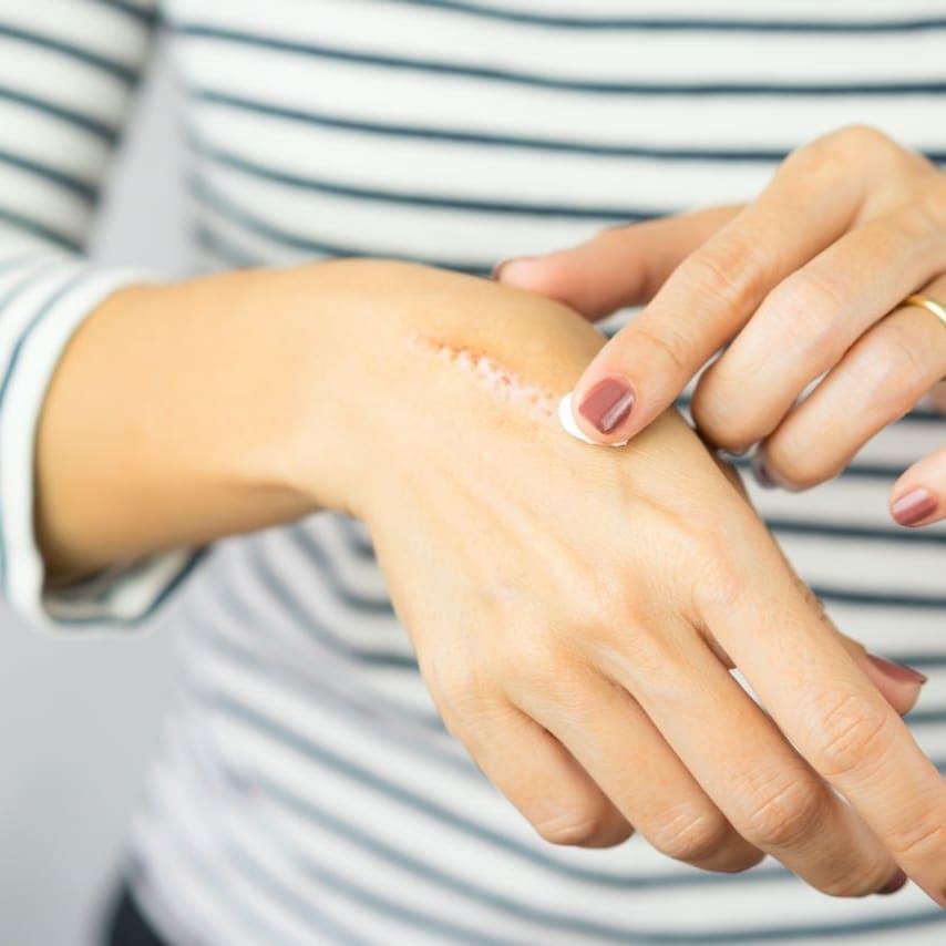 Everything You Need To Know About Treating Burns