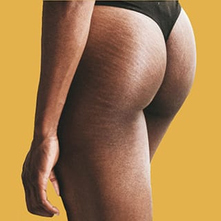 Butt Lift