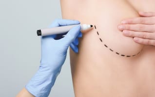 Here’s What You Need To Know About Replacing Breast Implants