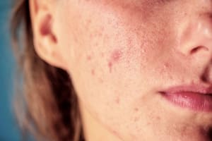 How To Treat The Most Common Types Of Face And Body Acne