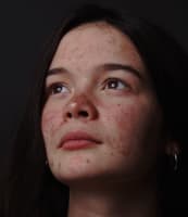 Oily Skin vs. Acne-Prone Skin: What’s The Difference?
