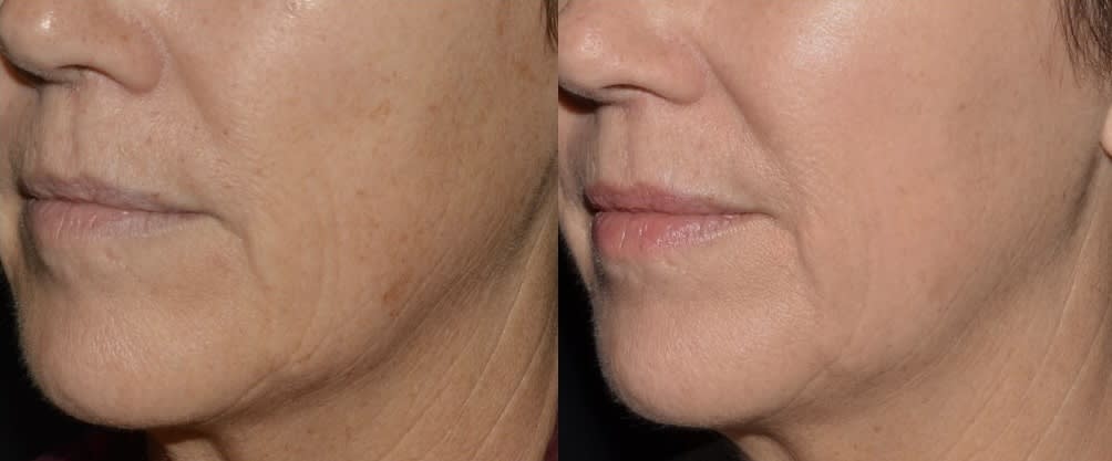 LaseMD Ultra Before and After
