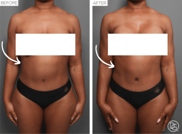 Dr. Daniel Gould, abdomen liposuction procedure. Before (left) after (right). Patient 09, Plastic Surgery Beverly Hills. 
