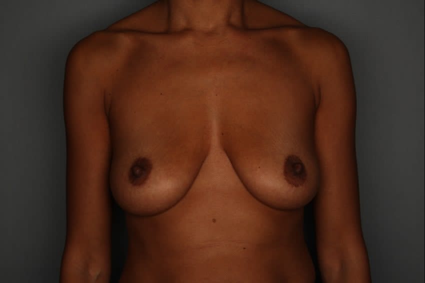 Breast Augmentation (Augmentation Mammaplasty) Before, undefined undefined - 1007