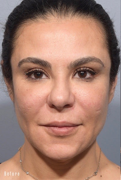Facelift Before, undefined undefined - 1844