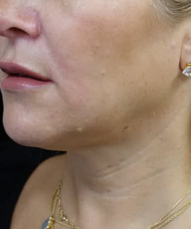 Kybella® After, undefined undefined - 3792