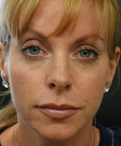 Dermal Filler & Injectable Solutions After, undefined undefined - 3791
