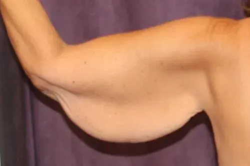 Arm Lift Before, undefined undefined - 4494