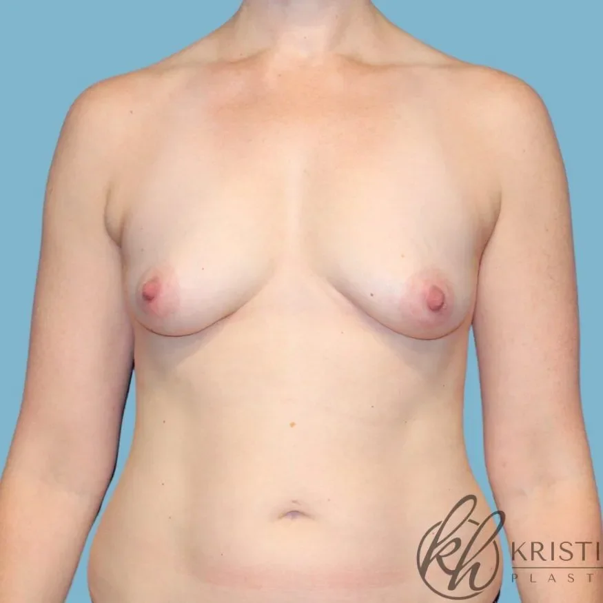 Breast Augmentation (Augmentation Mammaplasty) Before, undefined undefined - 4514
