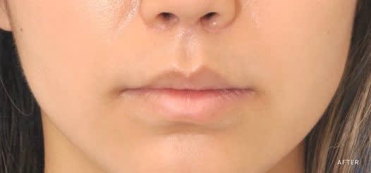 Subnasal 'Bullhorn' Lip Lift After, undefined undefined - 1934