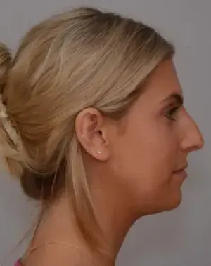 Rhinoplasty Before, undefined undefined - 4523