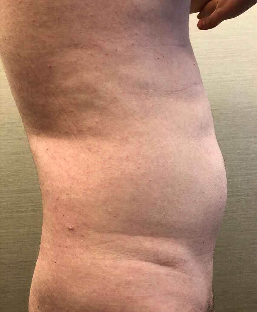 Liposuction Before, undefined undefined - 153
