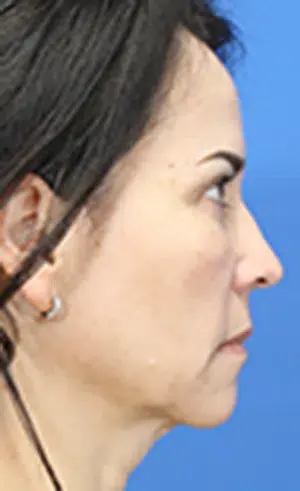 Neck & Jawline Definition Solutions Before, undefined undefined - 4177