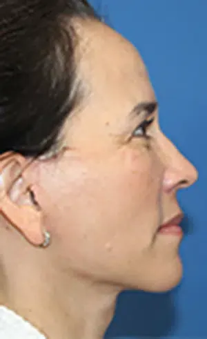 Neck & Jawline Definition Solutions After, undefined undefined - 4177