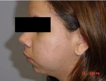 Chin Surgery (Mentoplasty) Before, undefined undefined - 1998