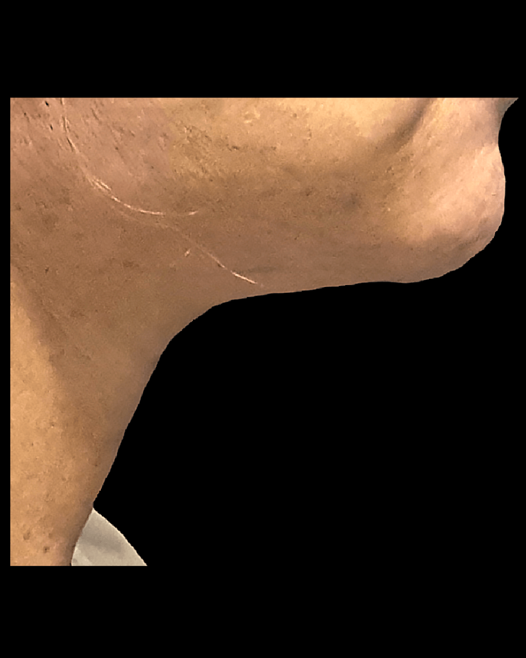 Neck Lift After, undefined undefined - 2113
