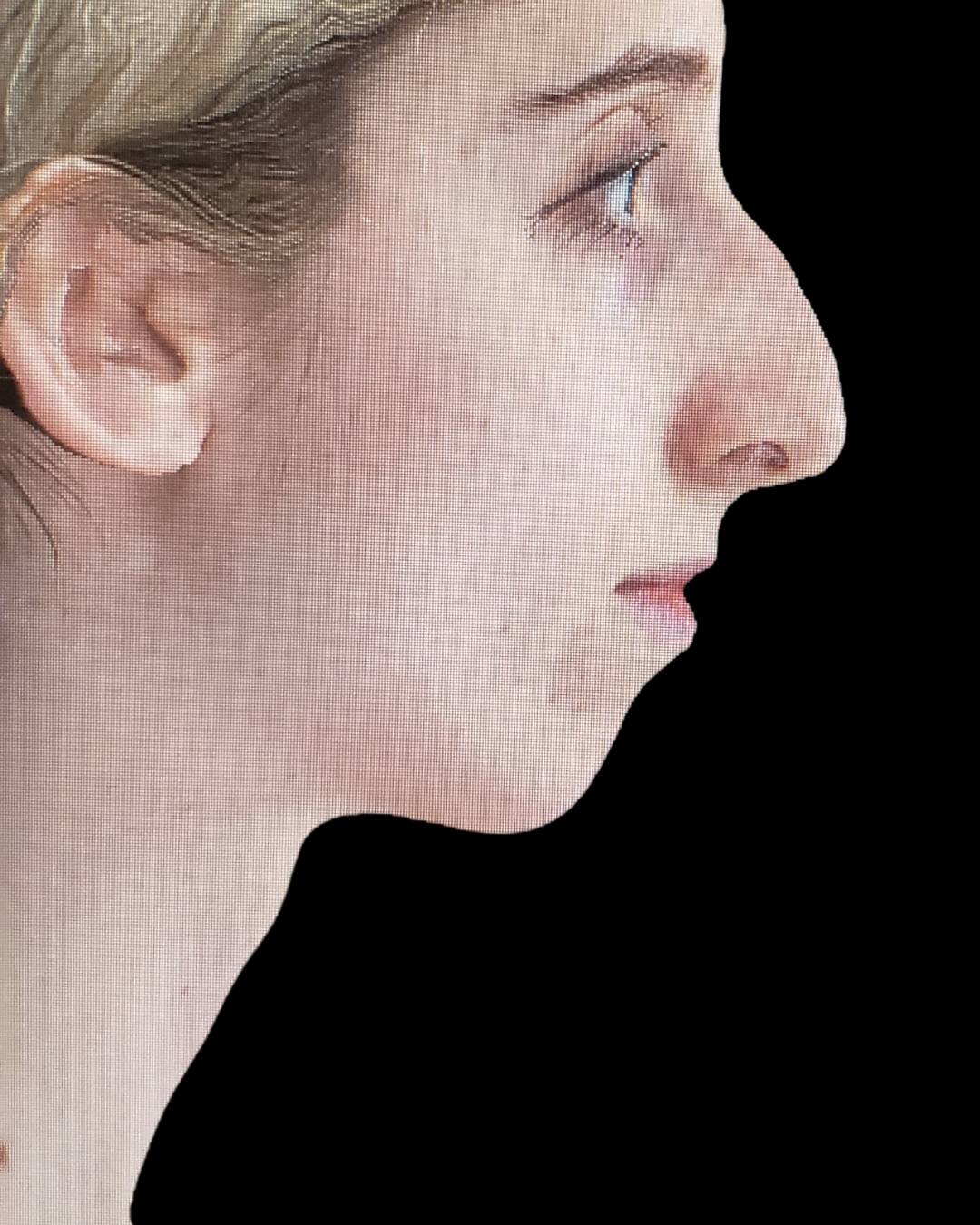 Rhinoplasty Before, undefined undefined - 1992