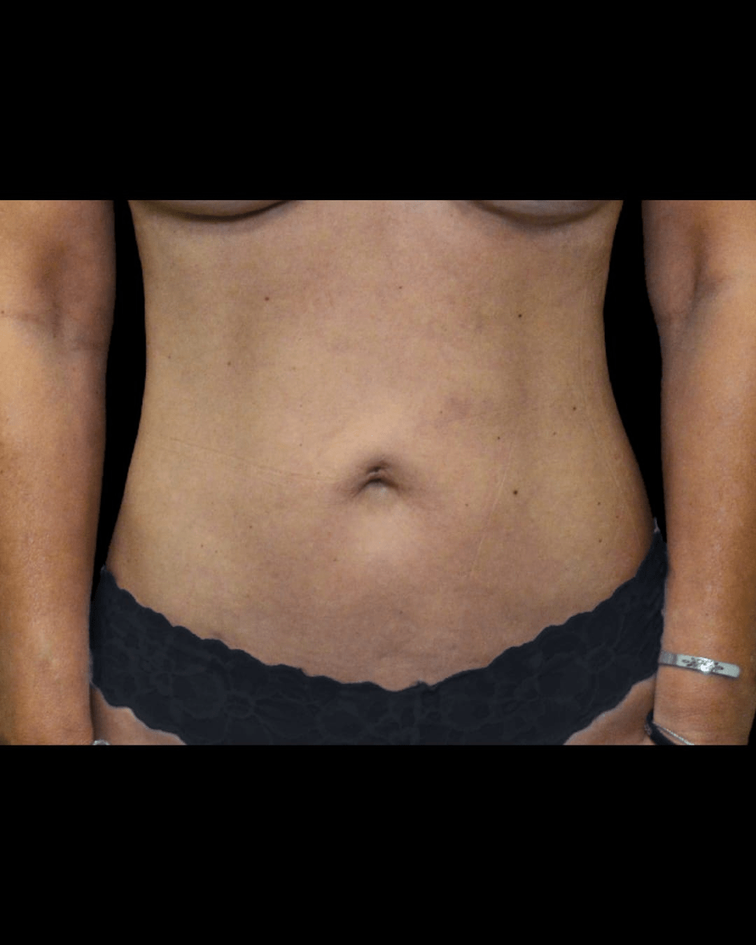 Liposuction After, undefined undefined - 2114