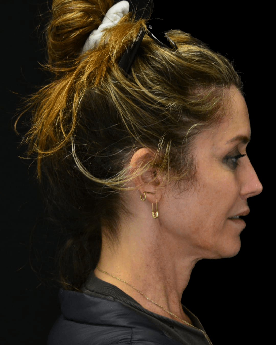 Facelift Before, undefined undefined - 2111