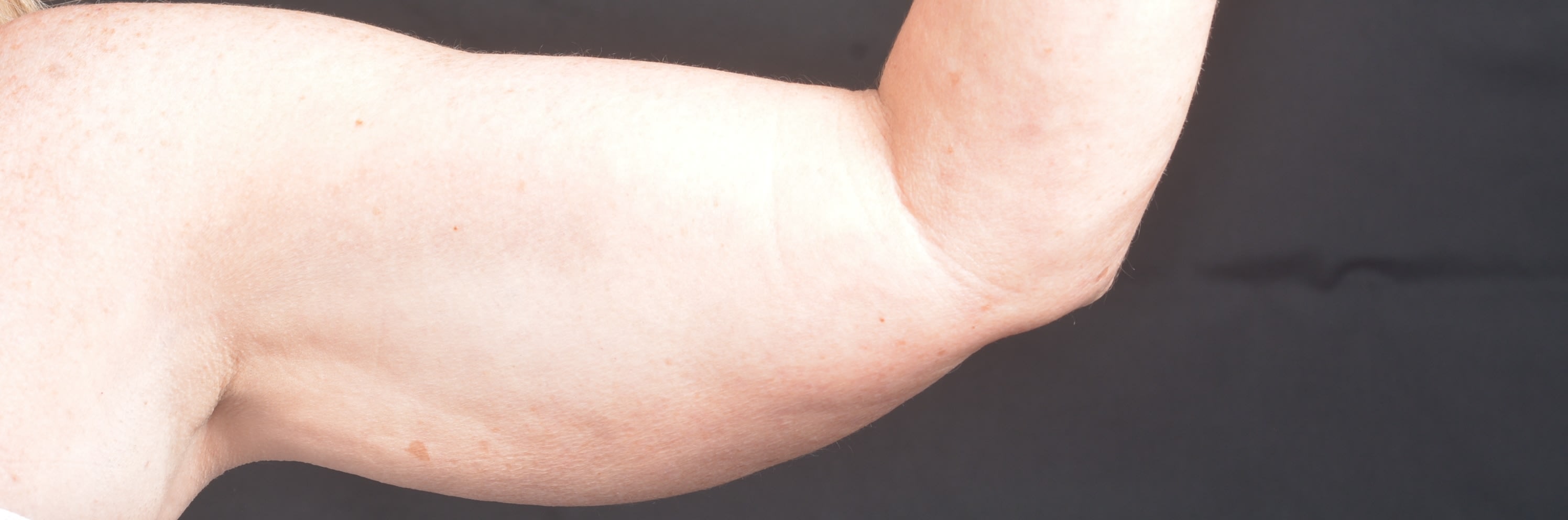 Arm Lift Before, undefined undefined - 83