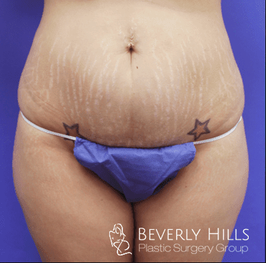 Abdominoplasty Before, undefined undefined - 423