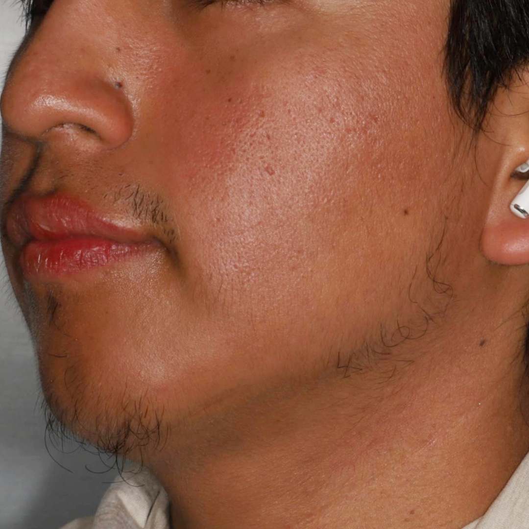Accutane After, undefined undefined - 4859