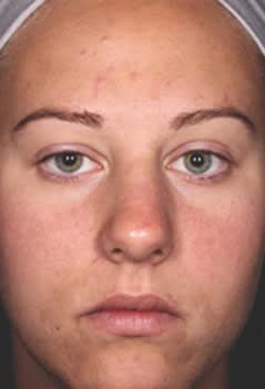 Acne Scar Treatment After, undefined undefined - 1362