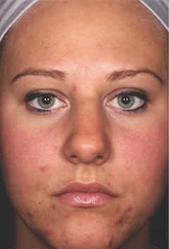 Acne Scar Treatment Before, undefined undefined - 1362