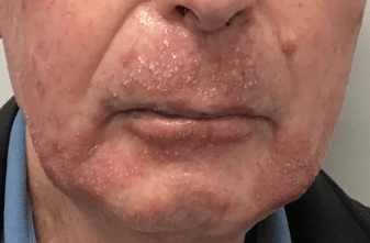 Acne Treatment Before, undefined undefined - 4131