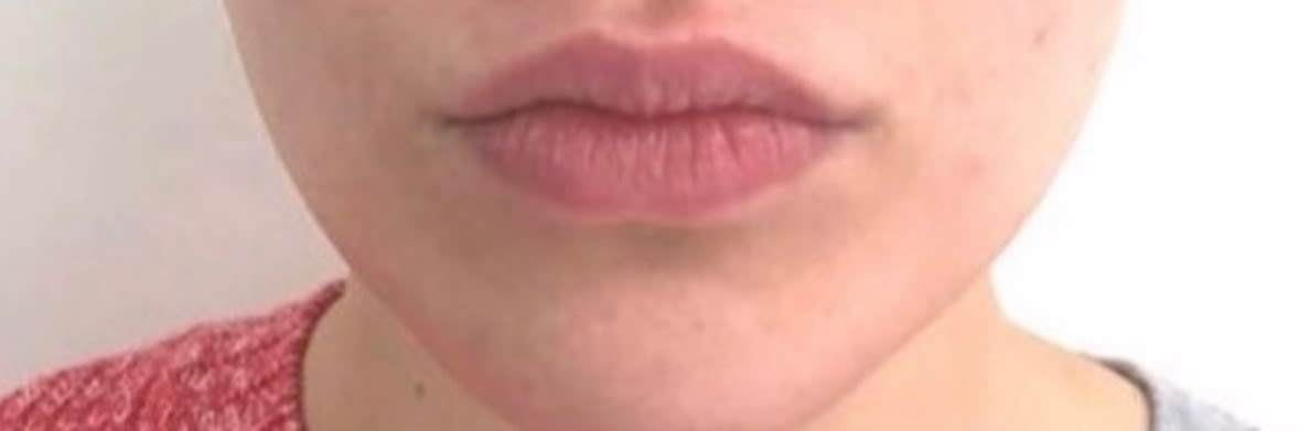Lip Augmentation and Injections Before, undefined undefined - 1705