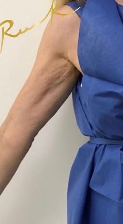 Dermal Fillers & Injectables Before, undefined undefined - 1706