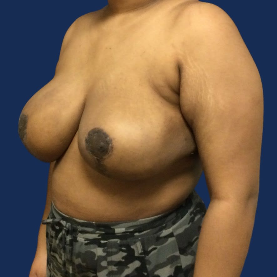 Breast Reduction After, undefined undefined - 3540
