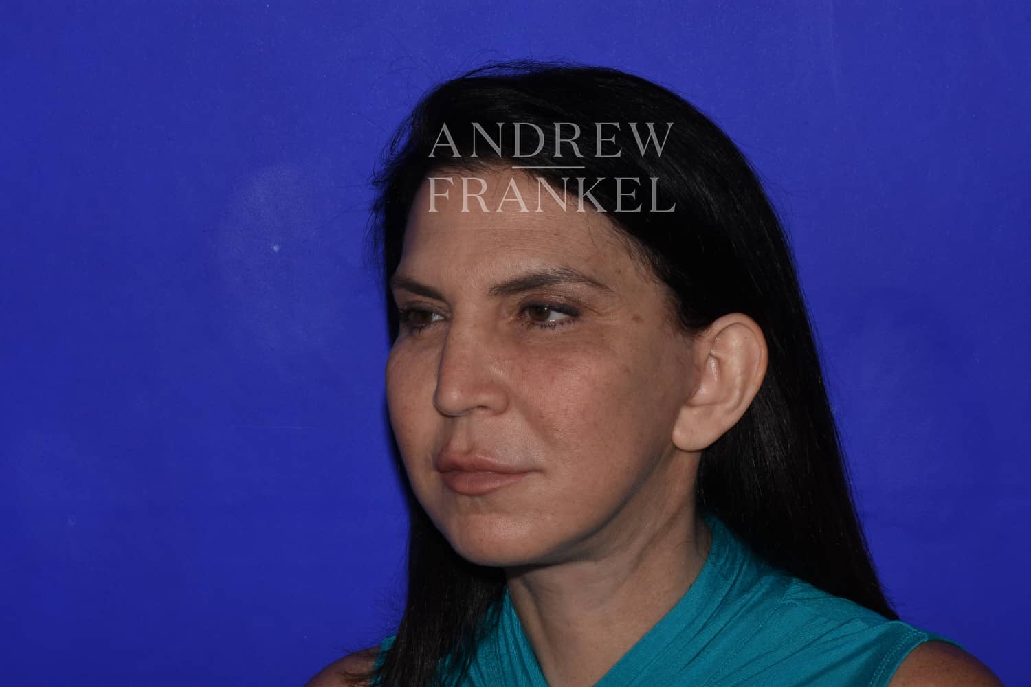 Mid-Facelift After, undefined undefined - 389
