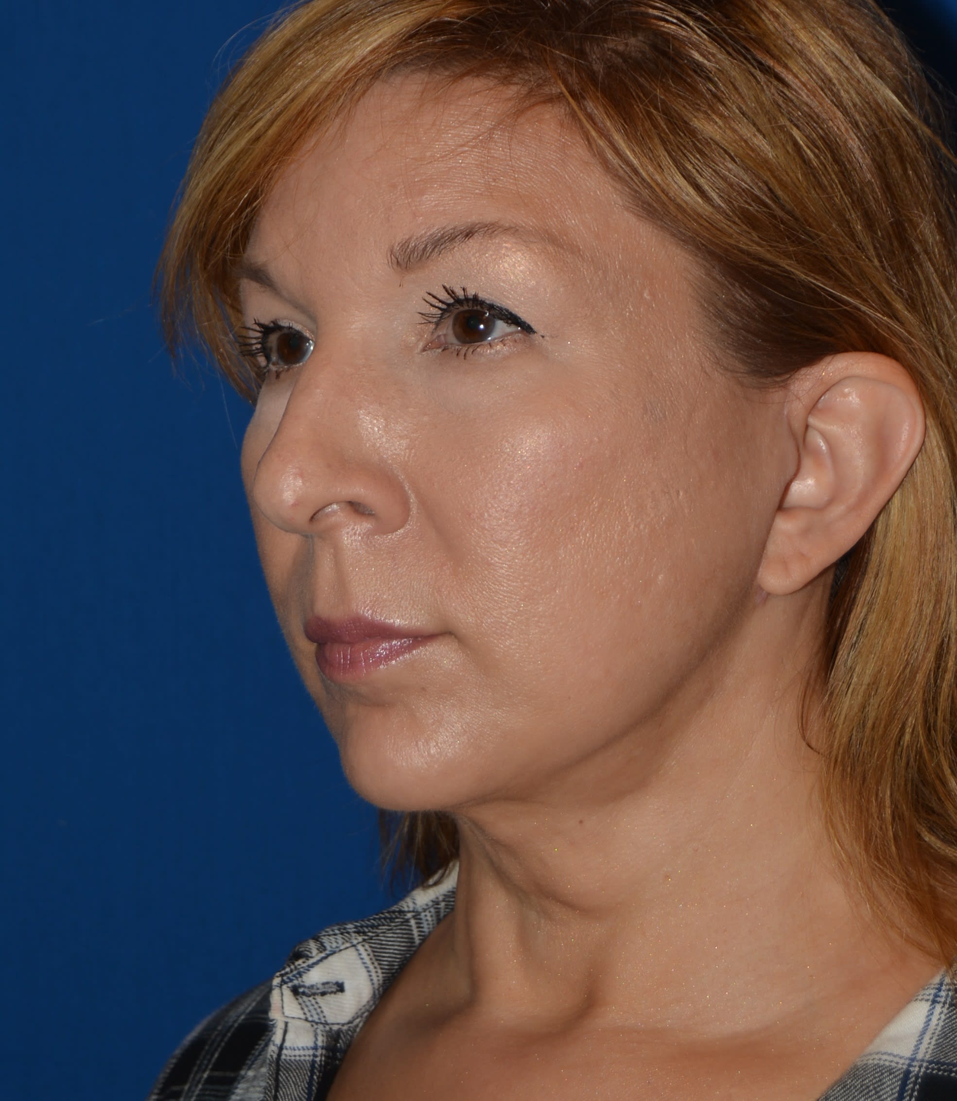 Facelift After, undefined undefined - 1517