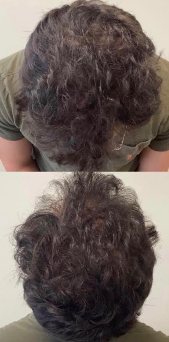 Platelet-Rich Plasma (PRP) Injections for Hair Loss After, undefined undefined - 652
