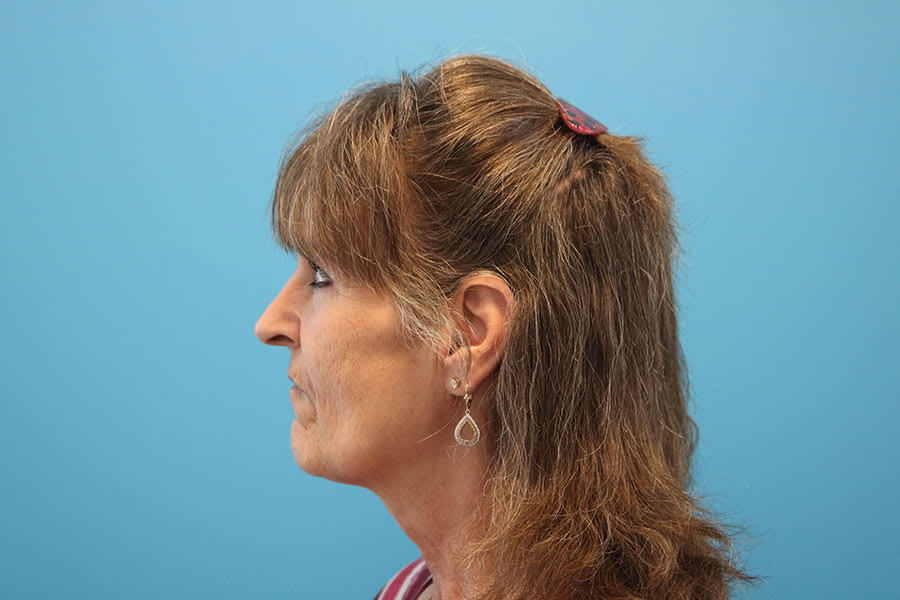 Alloplastic Chin Implant Before, undefined undefined - 2362