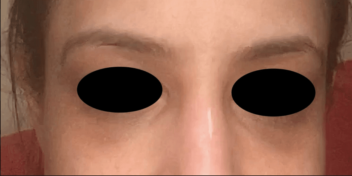 Under Eye Filler After, undefined undefined - 250