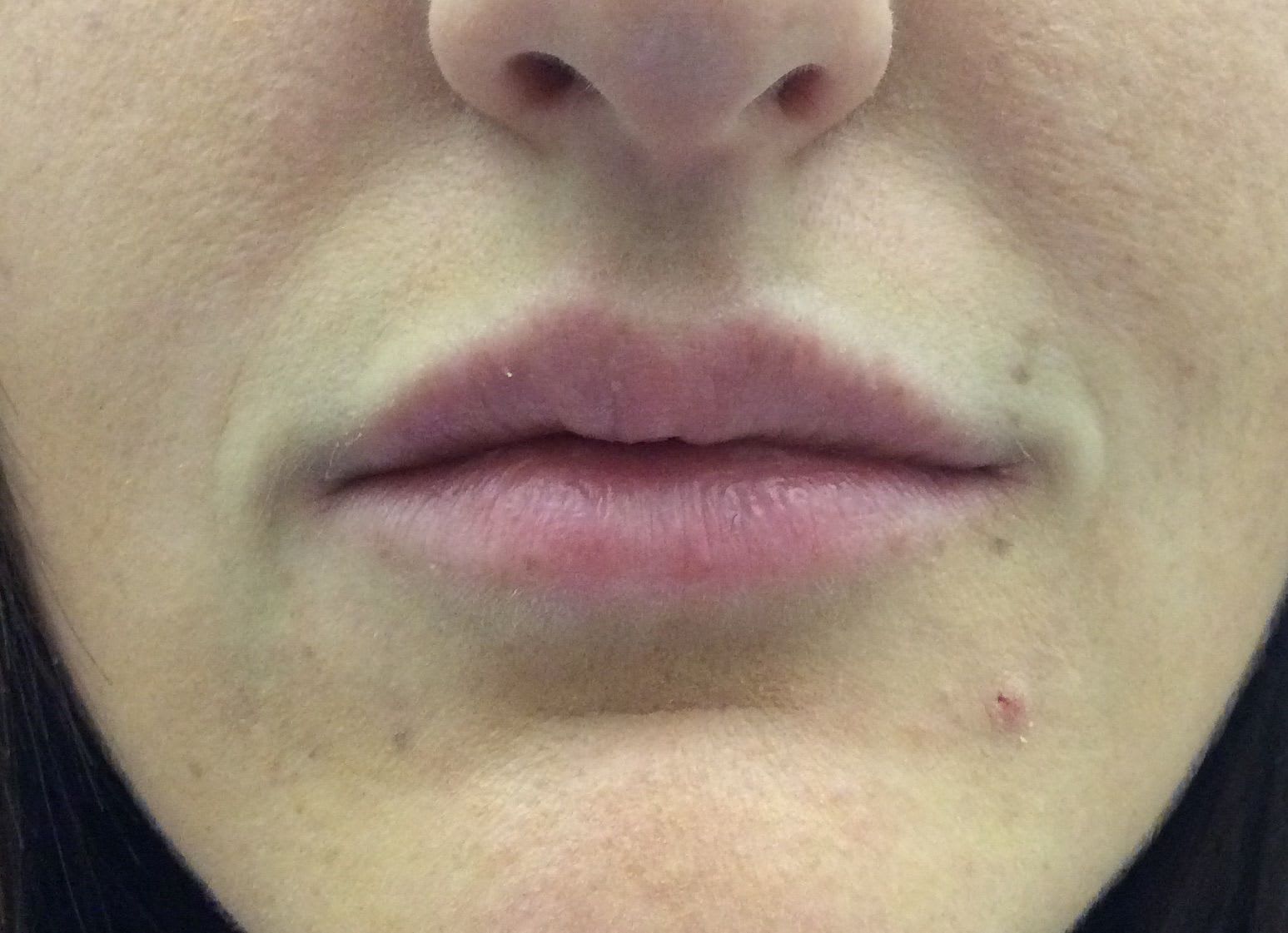 Temporary Lip Fillers After, undefined undefined - 253
