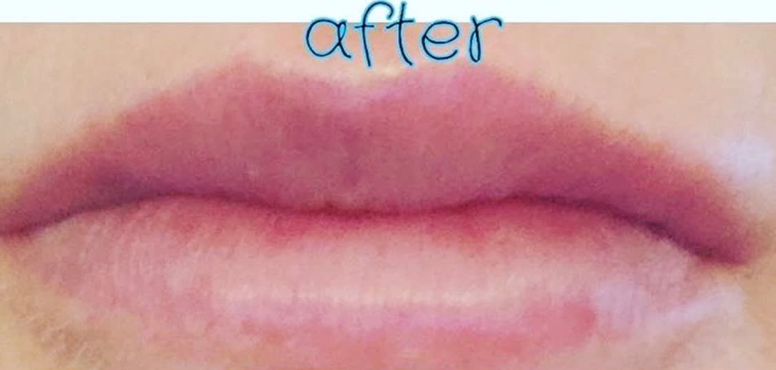 Lip Augmentation and Injections After, undefined undefined - 1715