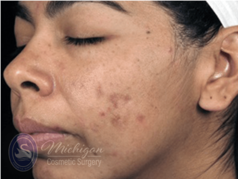 Acne Treatment Before, undefined undefined - 4282