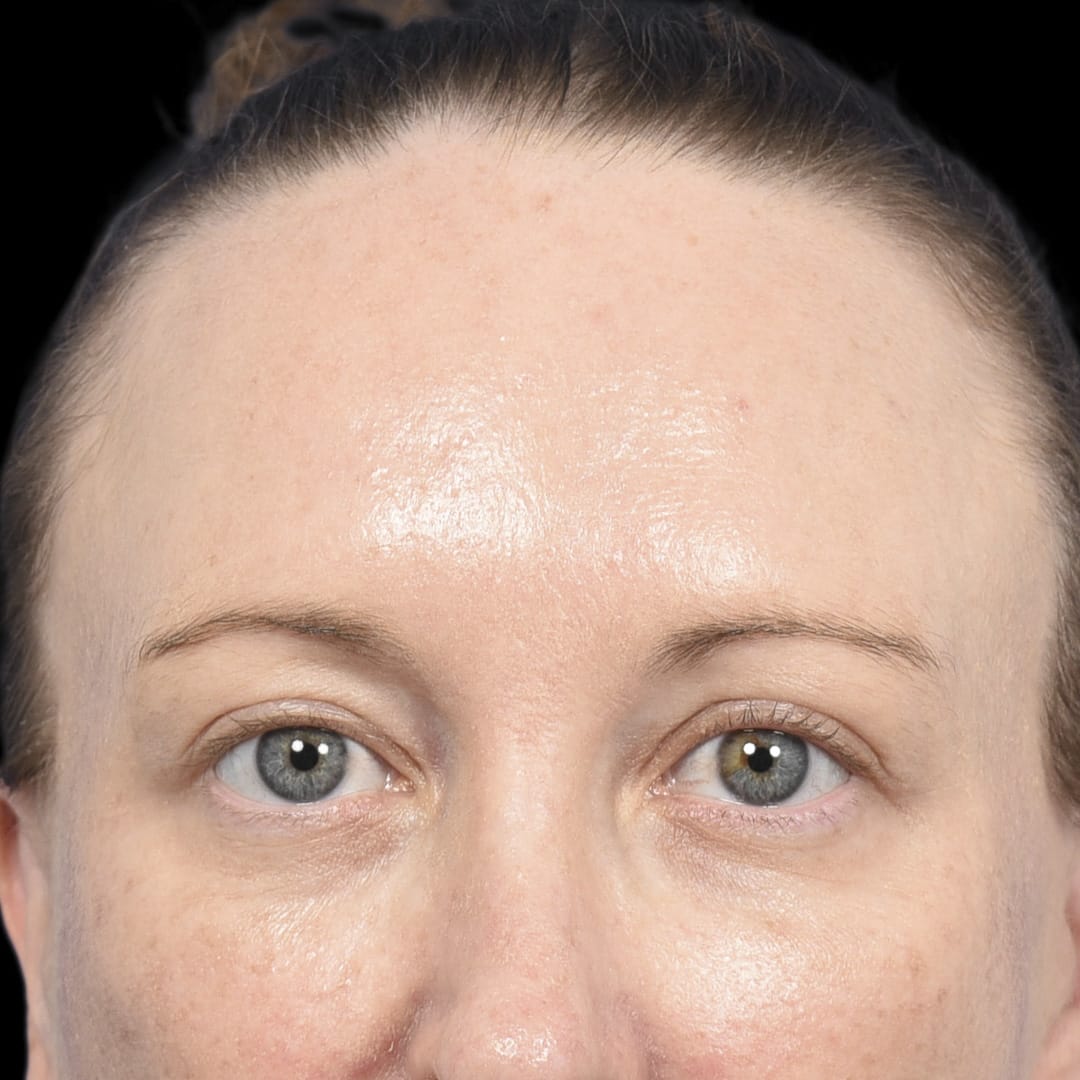 Brow Lift After, undefined undefined - 4886