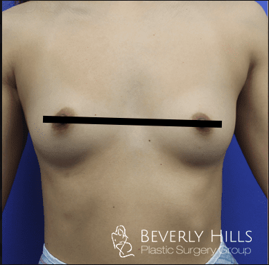 Breast Augmentation (Augmentation Mammaplasty) Before, undefined undefined - 418
