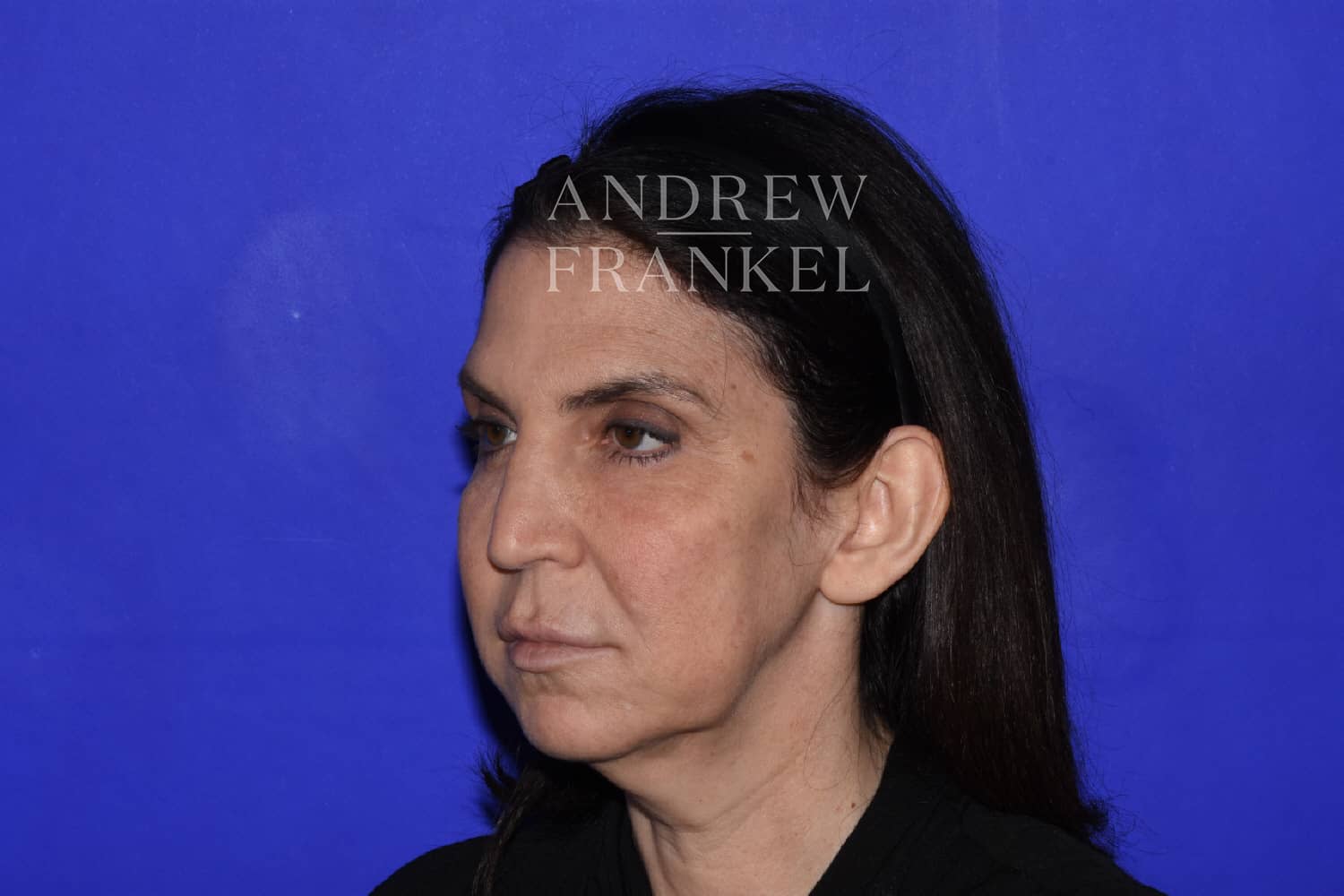 Mid-Facelift Before, undefined undefined - 389