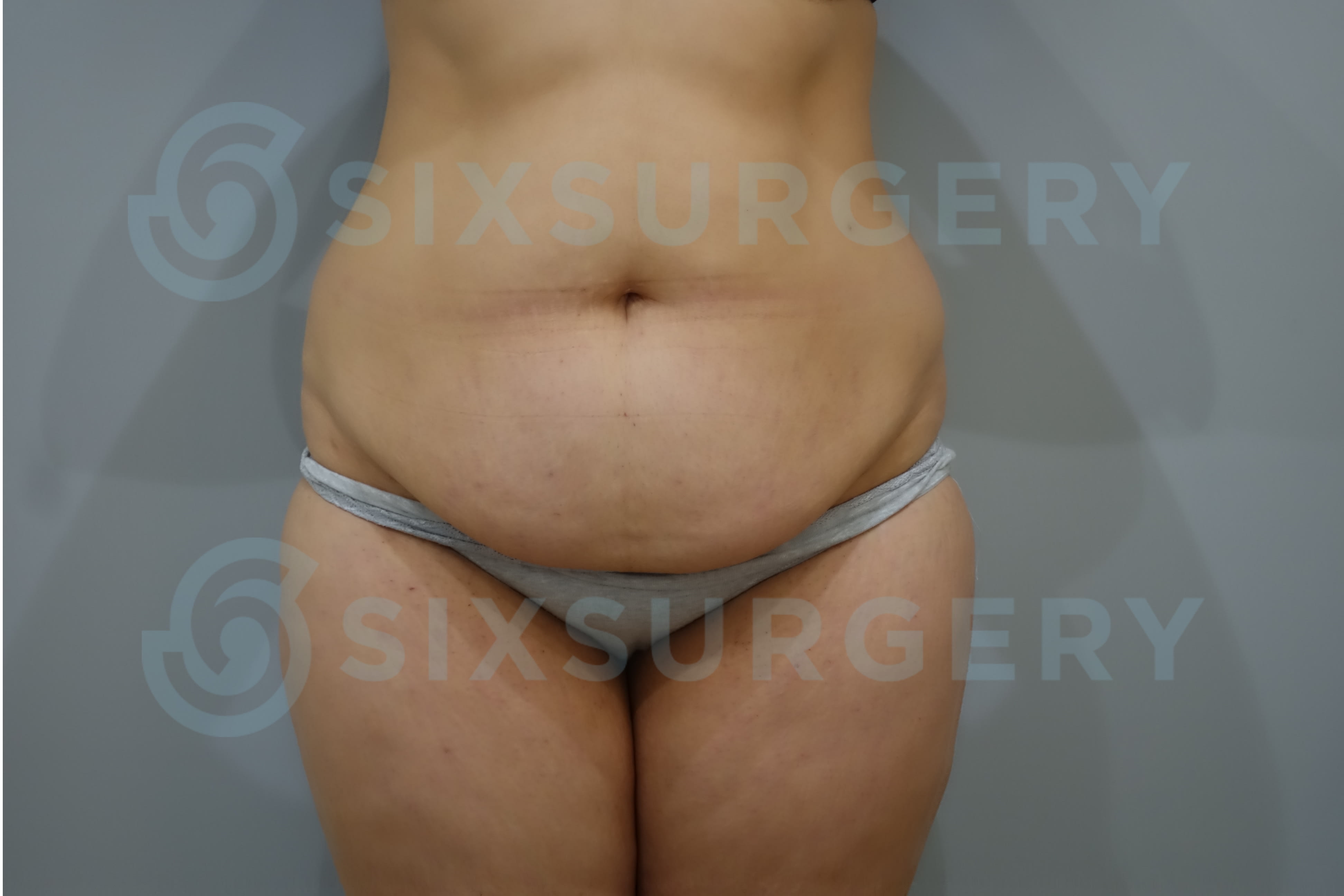 Tummy Tuck (Abdominoplasty) Before, undefined undefined - 1521