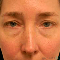 Blepharoplasty Before, undefined undefined - 2274