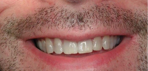 Teeth Whitening Before, undefined undefined - 1726
