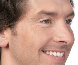 Dermal Fillers & Injectables After, undefined undefined - 2081